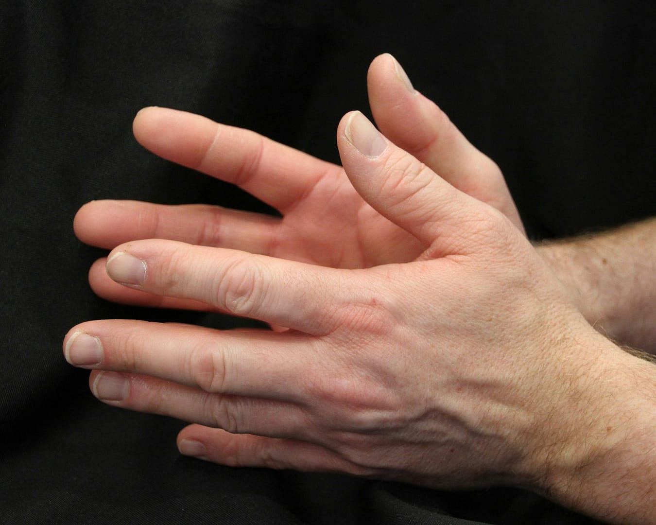 VEXAS Syndrome: Rare Immune Disorder