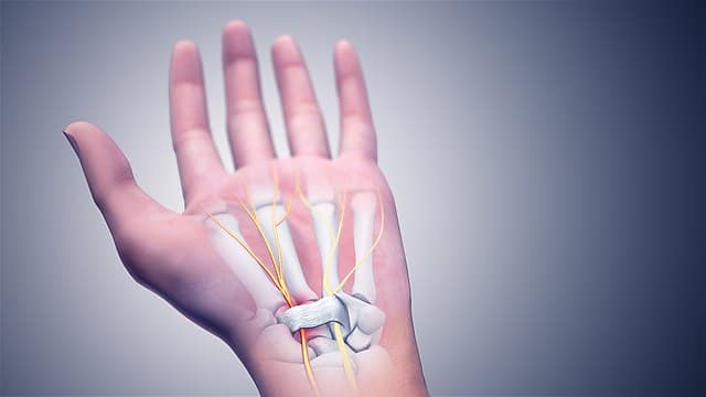 Home-Based Remedies for Carpal Tunnel Syndrome