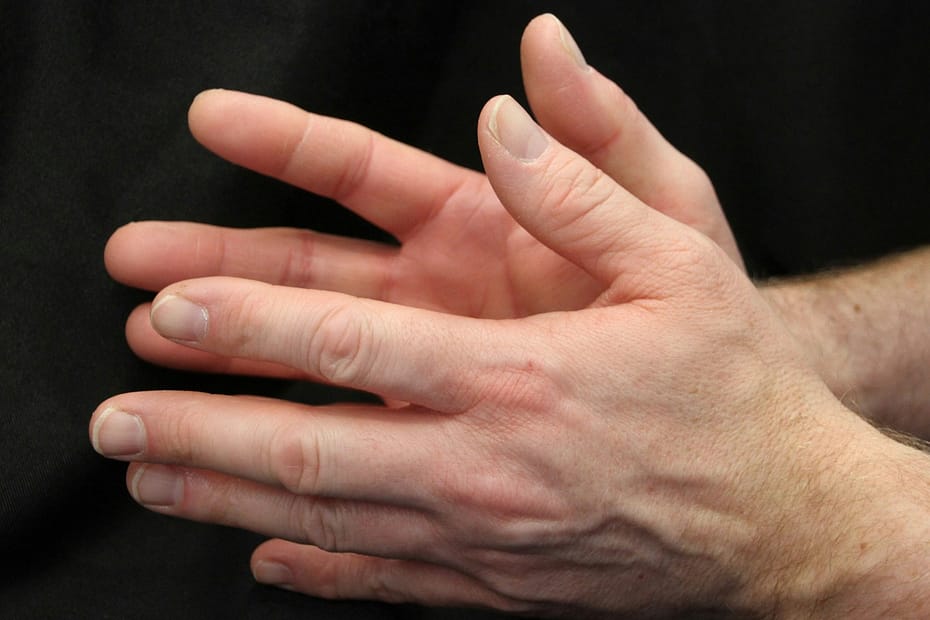 VEXAS Syndrome: Rare Immune Disorder